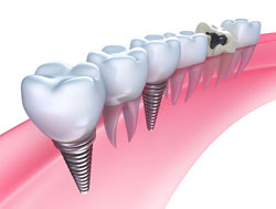 Dental Implants Harrisburg PA | Dentist 